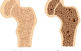 Arthritis & Rheumatic Disease Specialties, Florida, Aventura, Osteoporosis