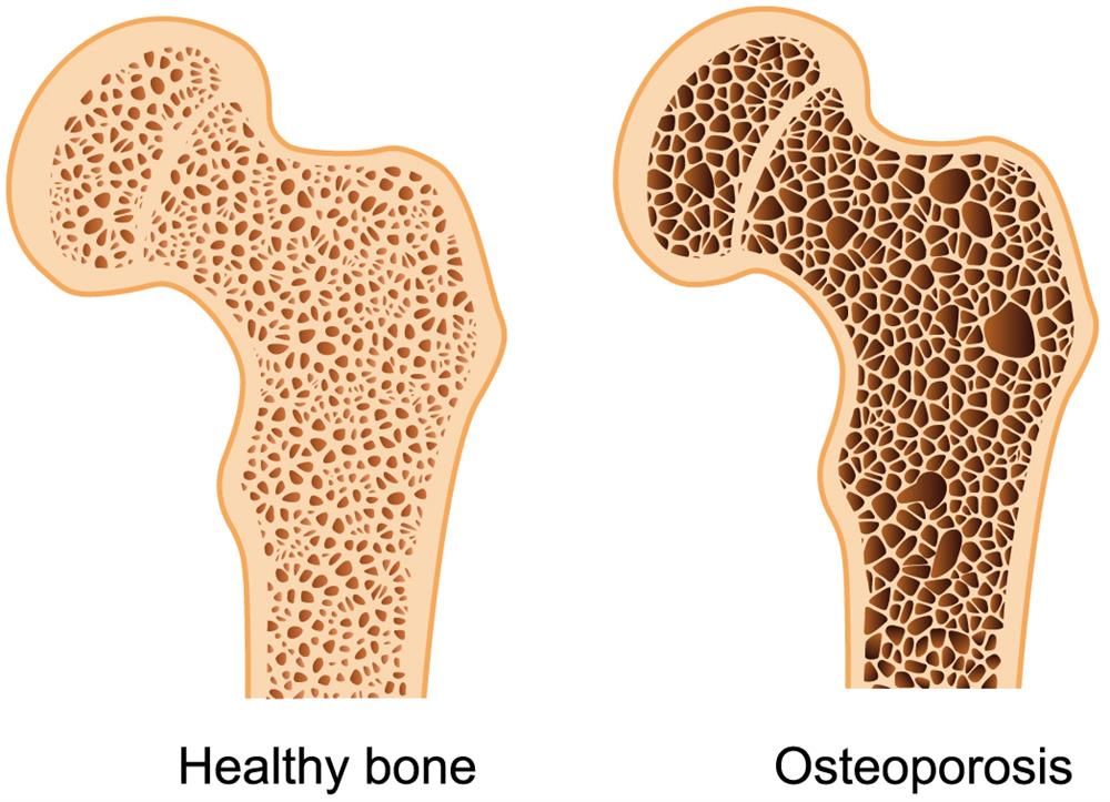 Arthritis & Rheumatic Disease Specialties, Florida, Aventura, Osteoporosis