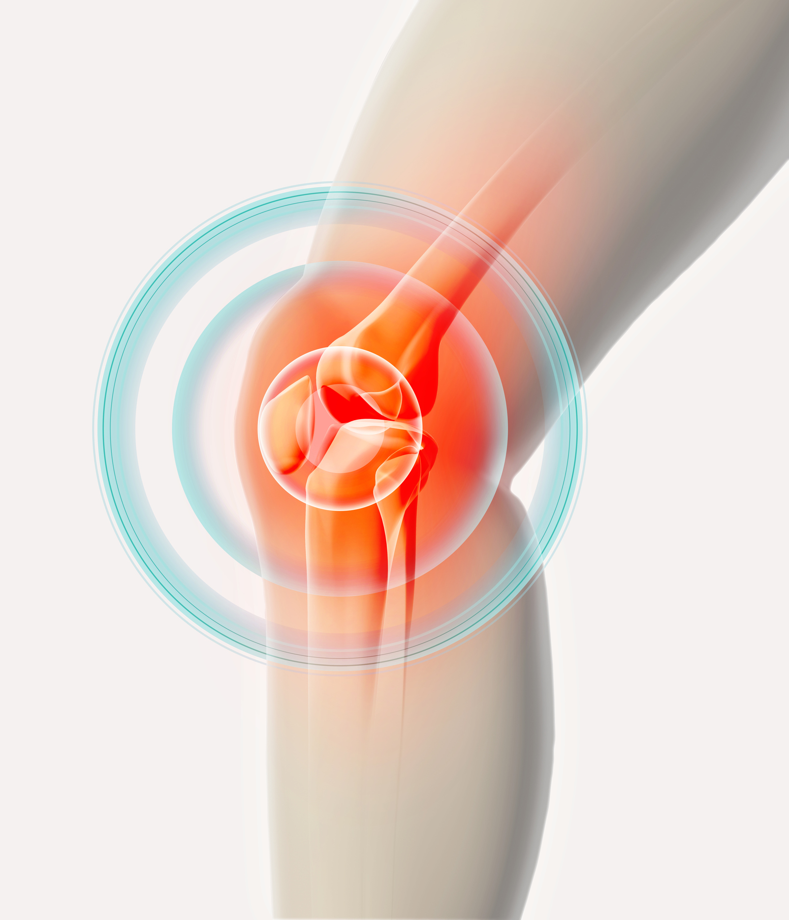 Arthritis & Rheumatic Disease Specialties, osteoarthritis of the knee, Look at Osteoarthritis Photo
