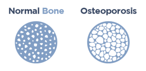 Osteoporosis condition, Bone Arthritis Rheumatics, Aventura, Florida, USA