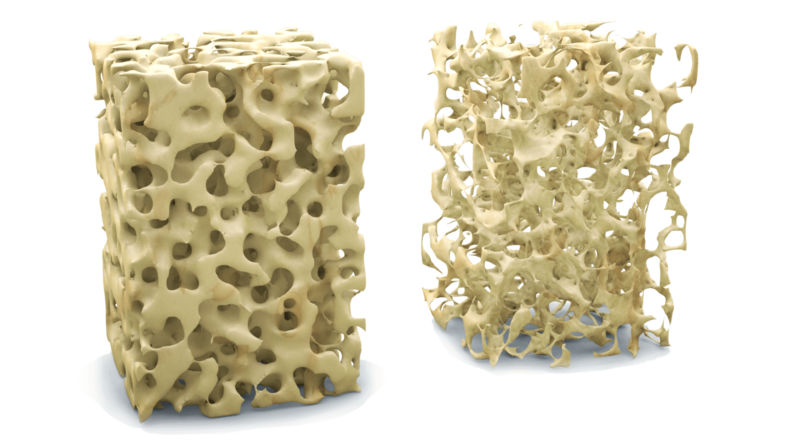 Osteoporosis effects on bones, Arthritis Rheumatics, Aventura, Florida